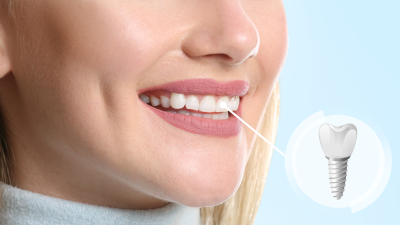 Why Dental Implants Are Becoming the Preferred Solution foMissing Teeth Among Americans